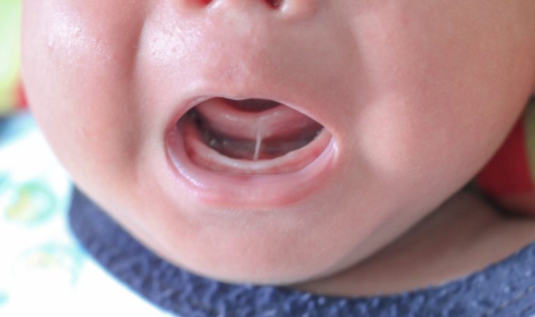 How to Breastfeed Your Tongue-Tied Baby